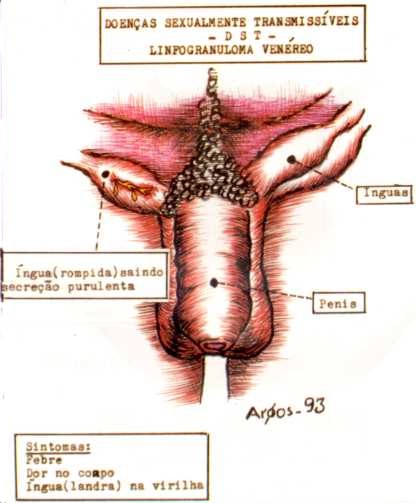 Lymphogranuloma Venereum: Background, Pathophysiology ...