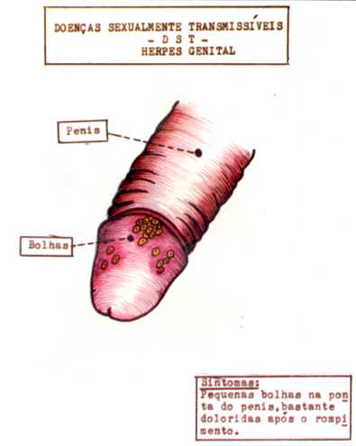 Genital Herpes in Men - STD Test Express