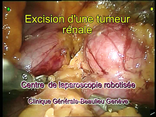 Excision d'une tumeur rénale / Removal of a kidney tumor - Charles-Henry Rochat (vidéo)