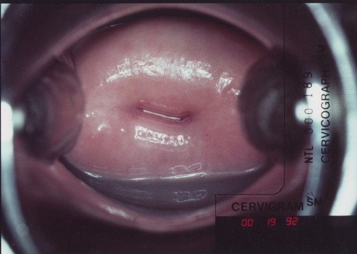 Aided Visual Inspection of the Cervix.