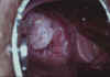 AIDED VISUAL INSPECTION OF THE CERVIX 11 MII11.jpg (51899 octets)