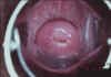 AIDED VISUAL INSPECTION OF THE CERVIX 13 MII13.jpg (56088 octets)