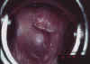 AIDED VISUAL INSPECTION OF THE CERVIX 14 MII14.jpg (52768 octets)