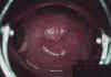 AIDED VISUAL INSPECTION OF THE CERVIX 15 MII15.jpg (47230 octets)
