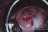 AIDED VISUAL INSPECTION OF THE CERVIX 17 MII17.jpg (51696 octets)