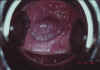 AIDED VISUAL INSPECTION OF THE CERVIX 18 MII18.jpg (56082 octets)