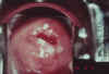 AIDED VISUAL INSPECTION OF THE CERVIX 19 MII19.jpg (57120 octets)