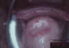 AIDED VISUAL INSPECTION OF THE CERVIX 20 MII20.jpg (42269 octets)
