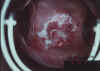 AIDED VISUAL INSPECTION OF THE CERVIX 22 MII22.jpg (54090 octets)