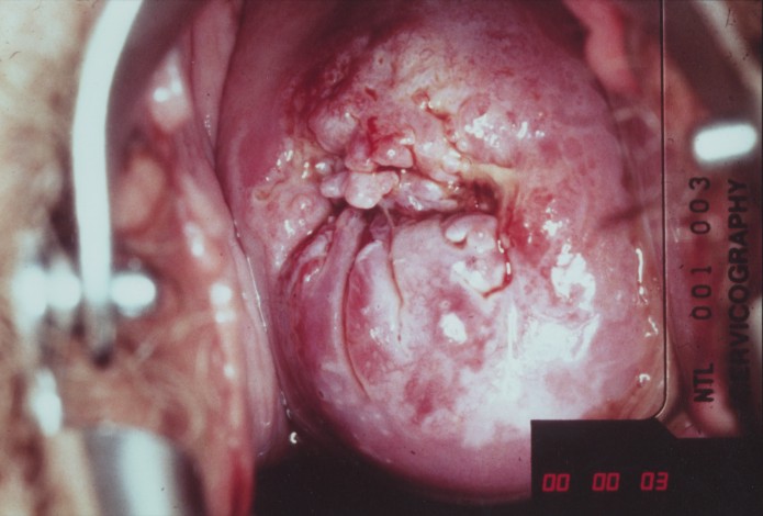 Squamous Carcinoma of Cervix +cell+carcinoma+cervix uterine cervix carcinom...