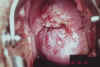 AIDED VISUAL INSPECTION OF THE CERVIX 23 MII23.jpg (64856 octets)