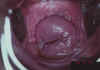 AIDED VISUAL INSPECTION OF THE CERVIX 2 MII2.jpg (52860 octets)