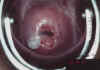 AIDED VISUAL INSPECTION OF THE CERVIX 3 MII3.jpg (57059 octets)
