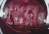 AIDED VISUAL INSPECTION OF THE CERVIX 4 MII4.jpg (62438 octets)