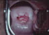 AIDED VISUAL INSPECTION OF THE CERVIX 5 MII5.jpg (53374 octets)