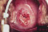 AIDED VISUAL INSPECTION OF THE CERVIX 6 MII6.jpg (61614 octets)