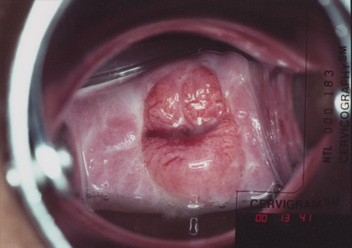 Aided Visual Inspection of the Cervix.