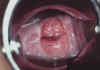 AIDED VISUAL INSPECTION OF THE CERVIX 7 MII7.jpg (56956 octets)