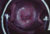 AIDED VISUAL INSPECTION OF THE CERVIX 8 MII8.jpg (49901 octets)