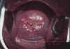 AIDED VISUAL INSPECTION OF THE CERVIX 9 MII9.jpg (54524 octets)