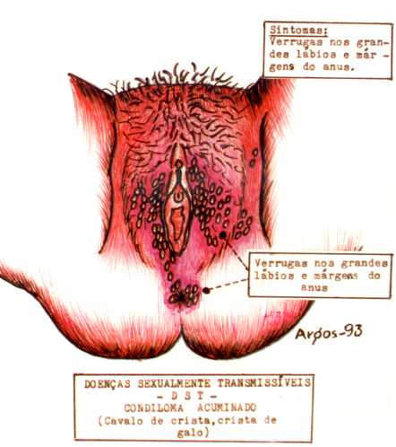 Condyloma (HPV) pénisz diagnosztikája és kezelése-STD szűrés
