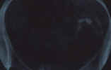 phimosis4.jpg (23502 octets)
