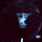 myome_sousmuqueux_4a.jpg (54863 octets)