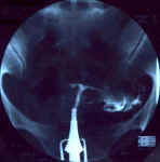 uterus_DES_2b.jpg (55870 octets)