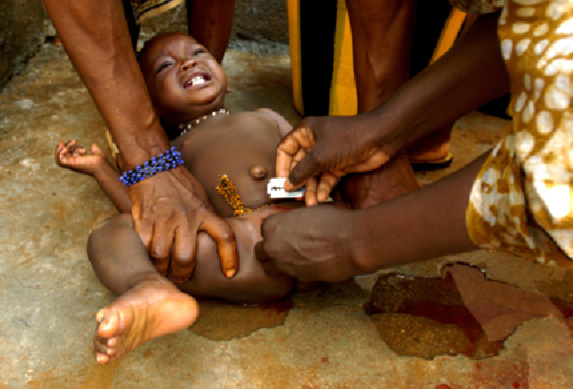 Mutilation génitale féminine