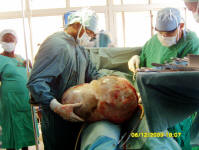 Chris Opoku Fofie - 23kg ovarian tumor