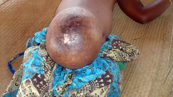Umbilical hernia during pregnancy in a young multiparous woman in Mozambique - Manuel Napúa