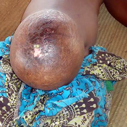 Umbilical hernia during pregnancy in a young multiparous woman in Mozambique - Manuel Napúa
